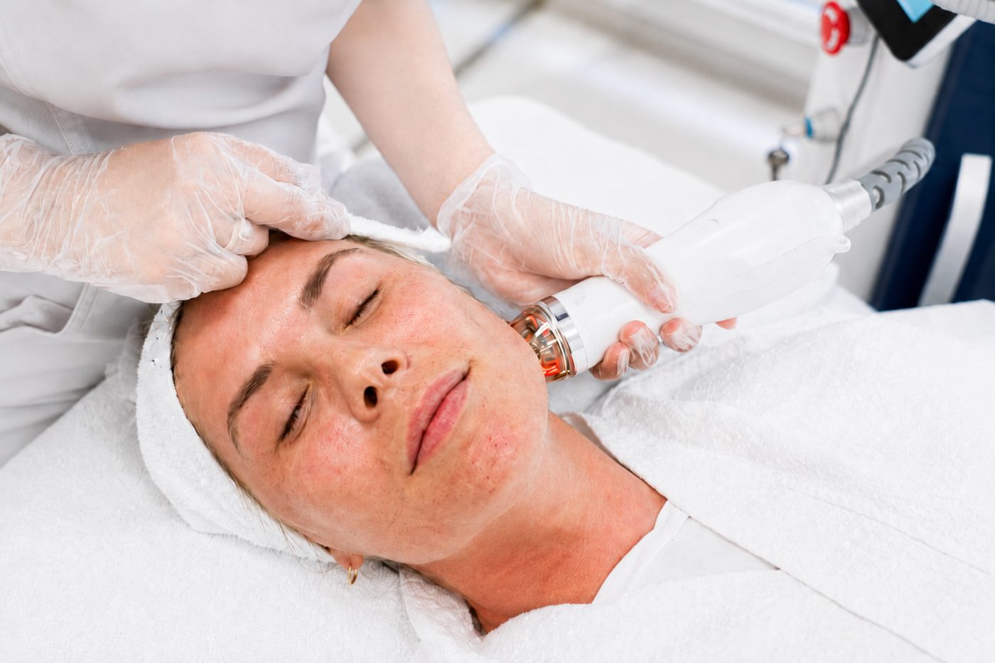 RF microneedling treatment